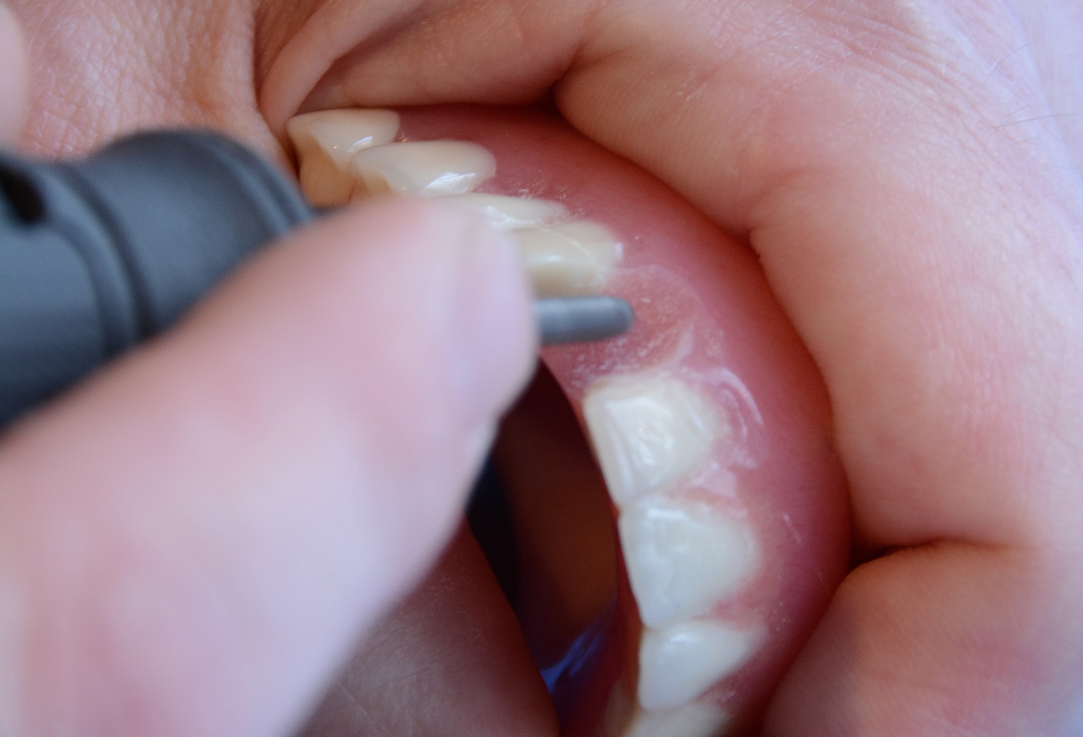 Denture repair work on blue background